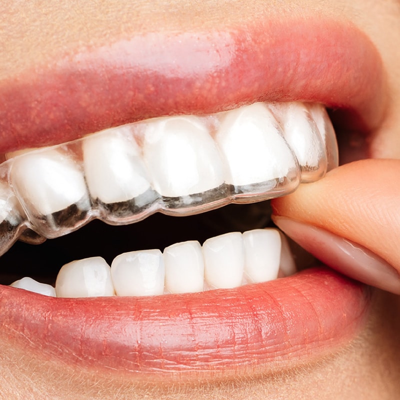 Clear aligners Alinea Orthodontics in Santa Monica, CA