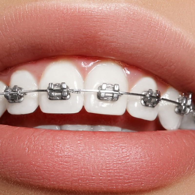 Metal braces at Alinea Orthodontics in Santa Monica, CA