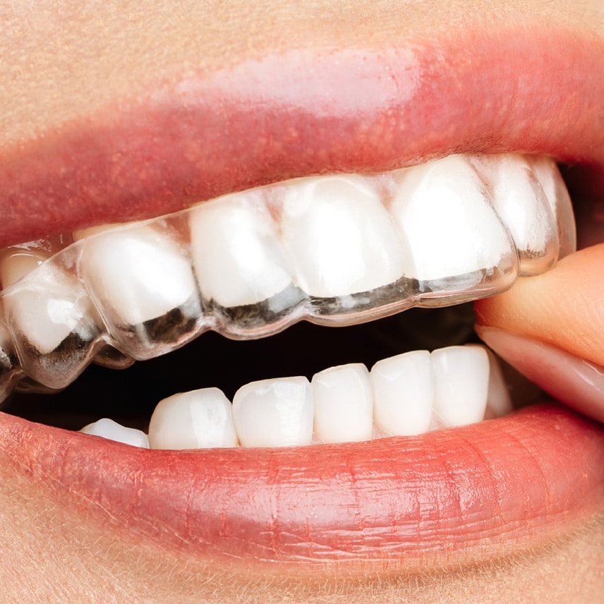 Invisalign aligner Alinea Orthodontics in Santa Monica, CA