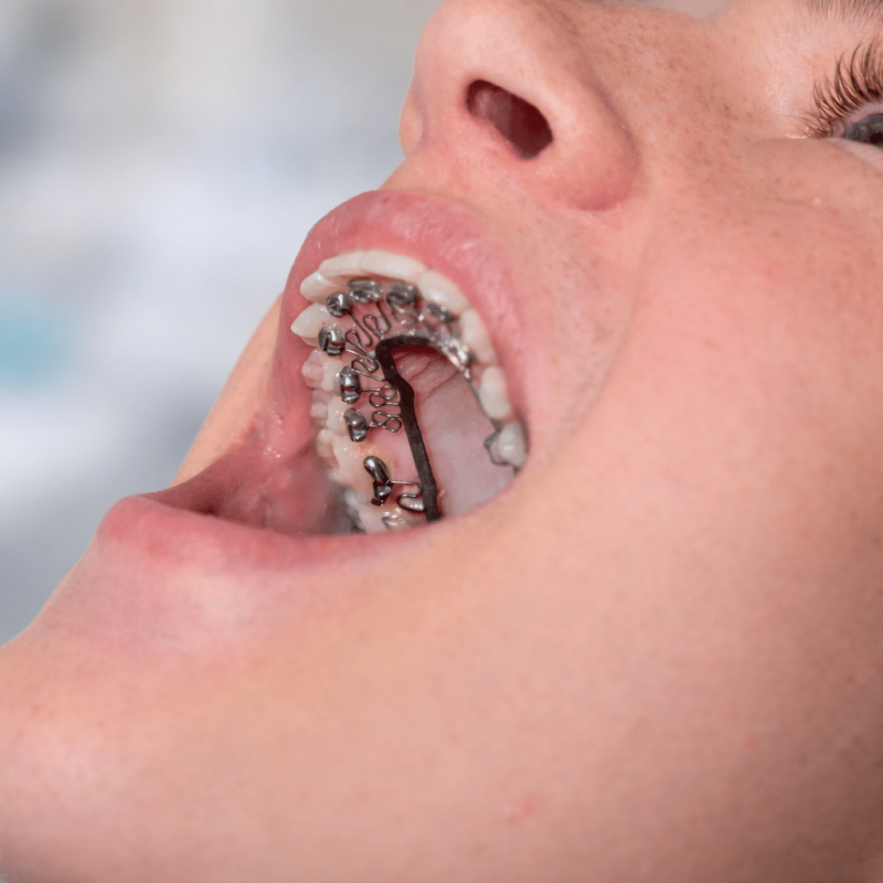 Brava Braces at Alinea Orthodontics in Santa Monica, CA